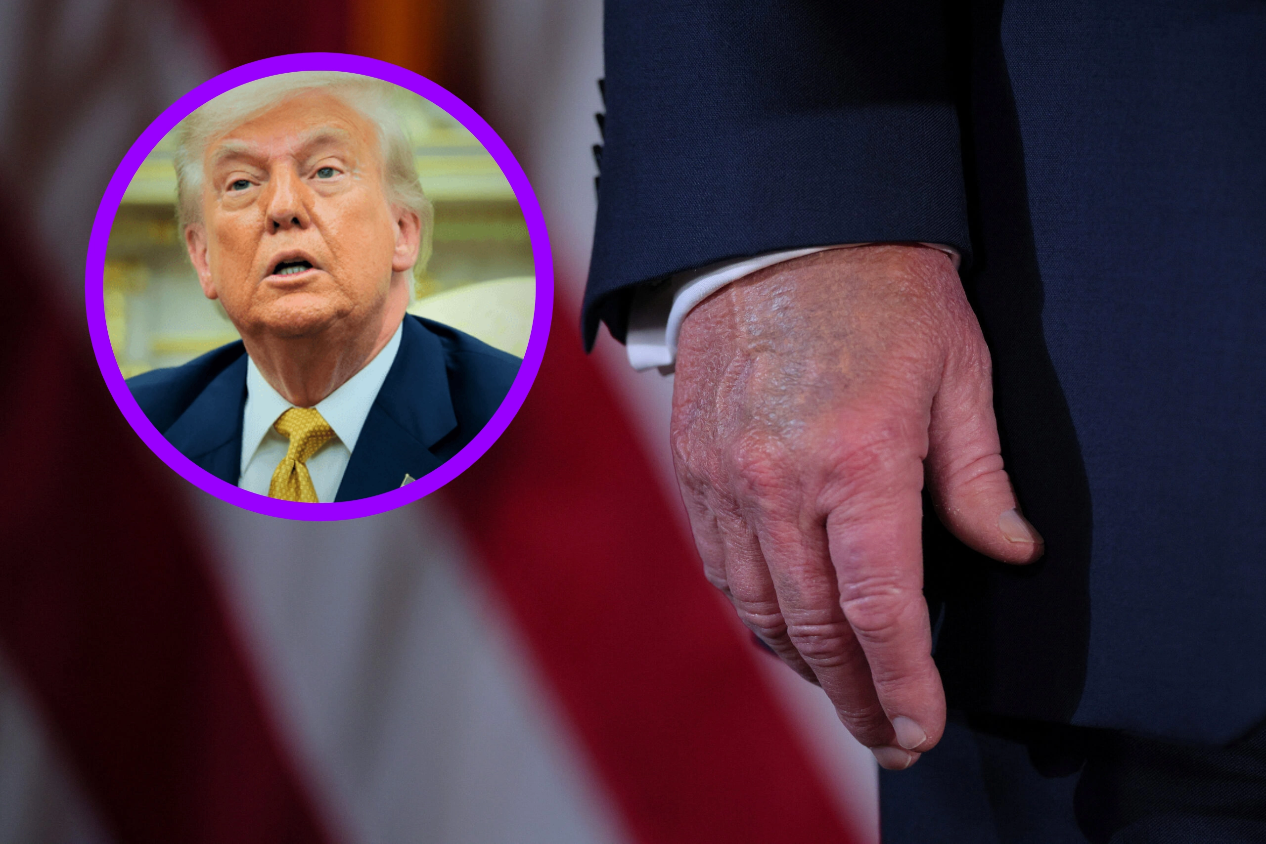 Donald Trump es diagnosticado con insuficiencia venosa crónica ¿Qué es?